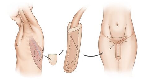 Muscle transplantation for enlarged penis