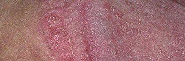Dry skin and ulcers on the penis head after using baking soda