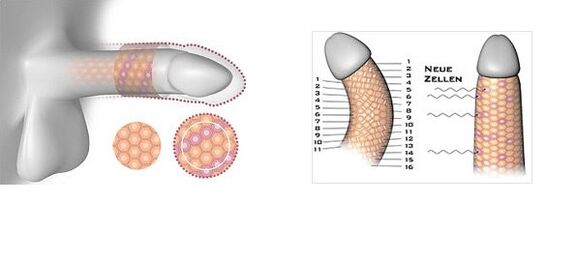 Penis enlargement surgery results