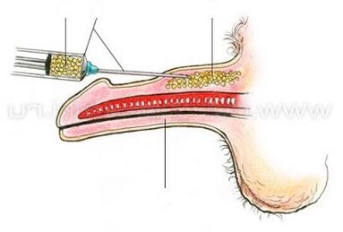 Penis enlargement injection