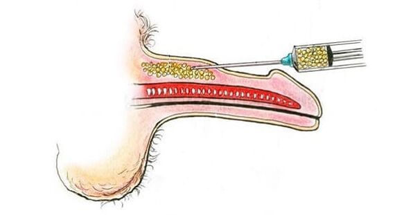 Muscle tissue transplantation for penis enlargement