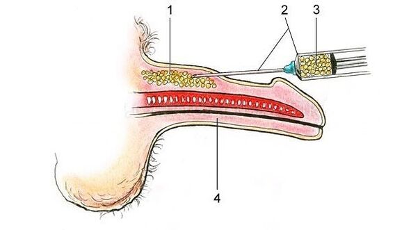 Inject hyaluronic acid to make penis thicker