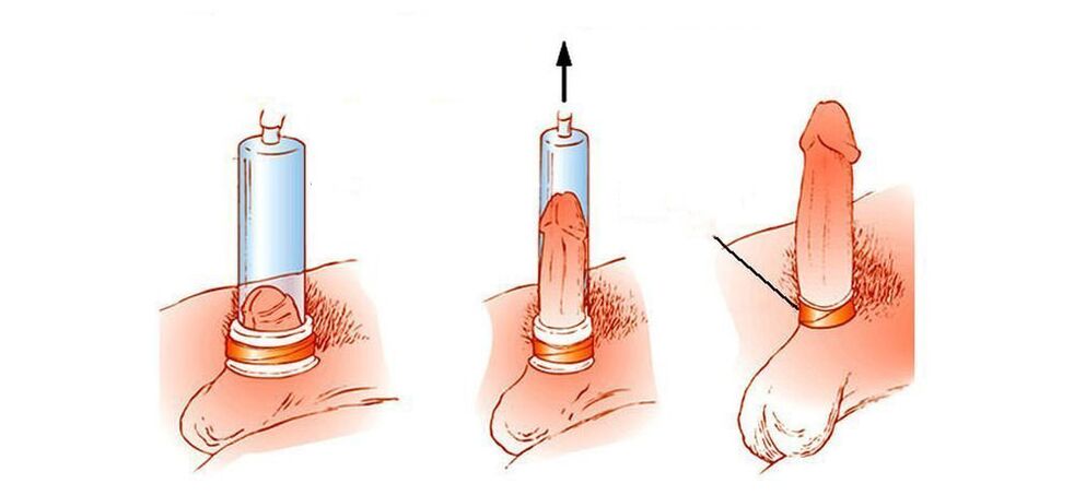 How does a penis vacuum pump work
