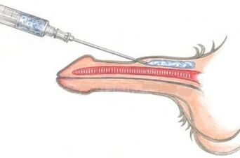The Dangerous Way to Use Vaseline Injections to Enlarge Your Penis